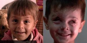 몸에서 유리조각 나오는 아이..시리아의 비극